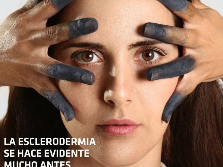 Esclerodermia, una de esas “enfermedades raras”