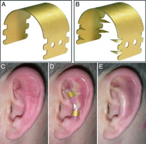 cómo funcionar earfold para solucionar las orejas de soplillo